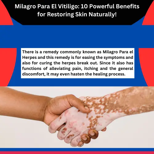 Milagro Para El Vitiligo